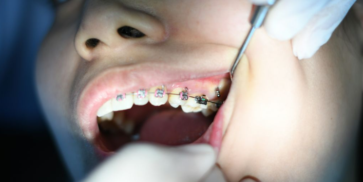 Achieve Your Dream Smile with Dental Implants in Everett