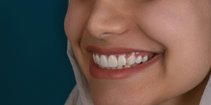 Achieve a Brighter Smile with Dental Implants in Wilmington