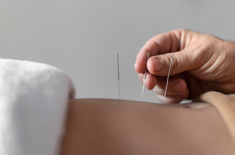 Dry Needling Explained: How This Innovative Therapy Relieves Muscle Pain and Tension